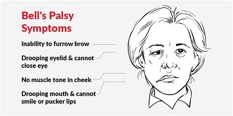 Drooping Face: How to Treat Bell’s Palsy with Physiotherapy - pt Health