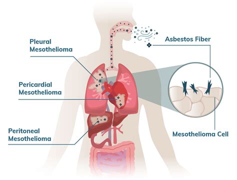 Malignant Mesothelioma Cancer | Stages, Prognosis, Treatment