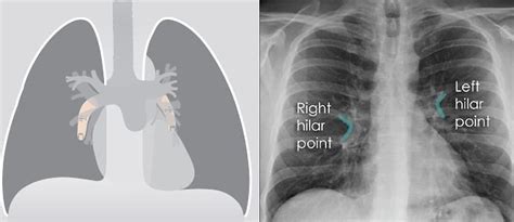 Chest Xray - Approach to hilum | Epomedicine