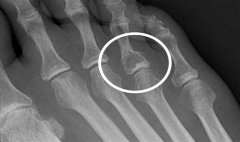 Fibrous Cortical Defect Definition, Symptoms, Causes, Treatment