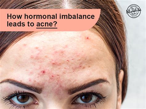 Hormonal Acne: Causes and Treatment