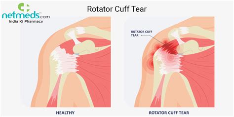 Rotator Cuff Injury Including Rotator Cuff Tear, Rotator Cuff Bursitis ...