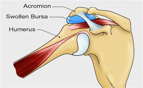 Subacromial Bursitis - Masnad Health Clinic