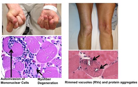 Myositis - Lisbeth Laster