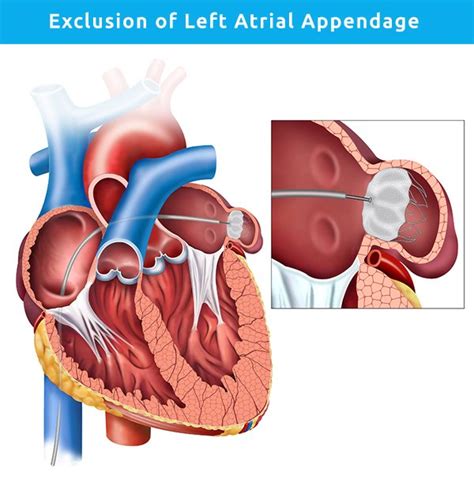 Left Atrial Appendage Closure Procedure