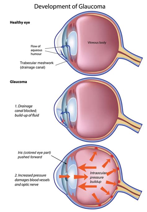 Glaucoma - High Internal Eye Pressure That Causes Vision Loss