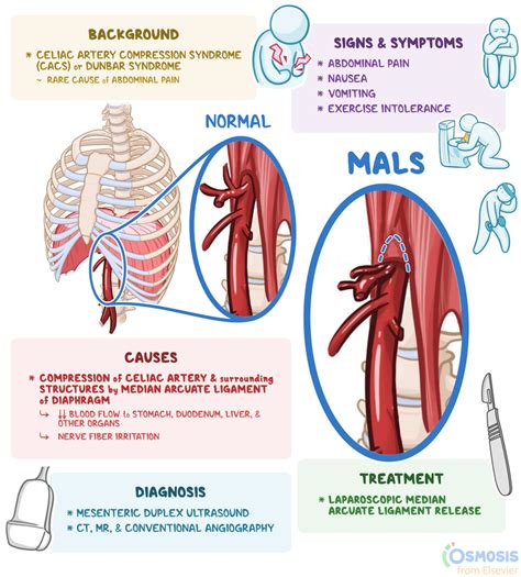 Median Arcuate Ligament Syndrome (MALS): What Is It, Causes, Symptoms ...