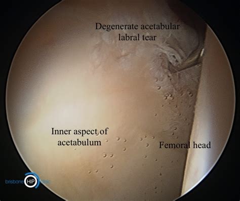 Acetabular Labral Tear - Brisbane Hip Clinic Australia