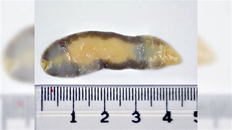 What Do Roundworms Look Like In Human Stool - Infoupdate.org