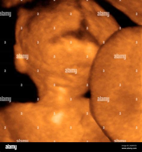 Foetus. Coloured 3-D ultrasound scan of the back of a foetus' head. The ...