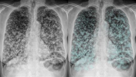 Chest X-ray - Lung cancer - Metastases (to lung)