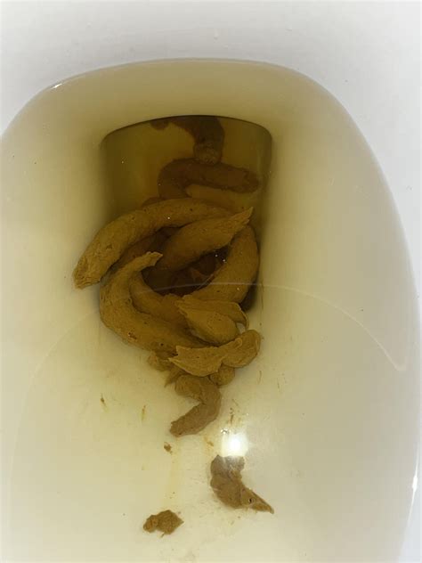 What Does Colon Cancer Poop Look Like – NBKomputer