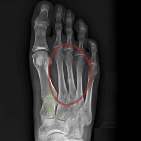 Xray Of Foot Stress Fracture