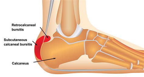 Achilles Bursitis | Retrocalcaneal Bursitis - Symptoms, Causes & Treatment