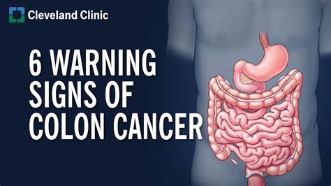 What are the Symptoms for Colon Cancer - en.healthd-sports