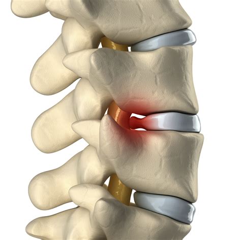 Herniated Disc / Bulging Disc / Protruding Disc - Michigan Spine & Pain