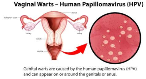 Genital Warts On Testicles