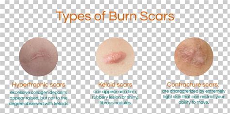 Burn Scar Contracture Hypertrophic Scar Keloid PNG, Clipart, Acne, Aloe ...