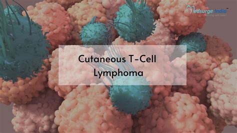 Cutaneous T-Cell Lymphoma Treatment Cost In India | Medsurge India