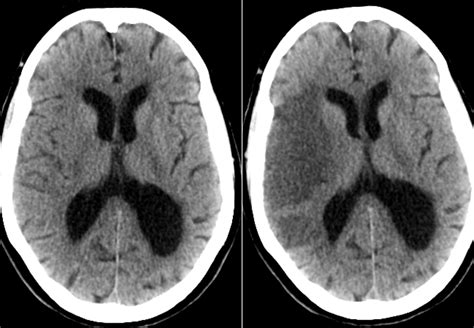 Infarction, middle cerebral artery; Cerebral Infarction, Middle ...