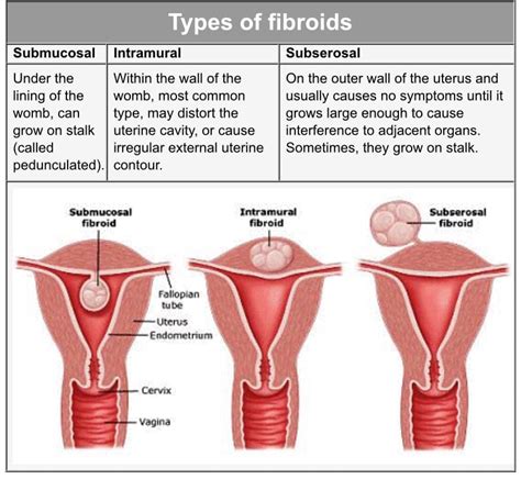 Myomectomy Surgery, Uterine Fibroids Treatment in Thane, Mumbai, India