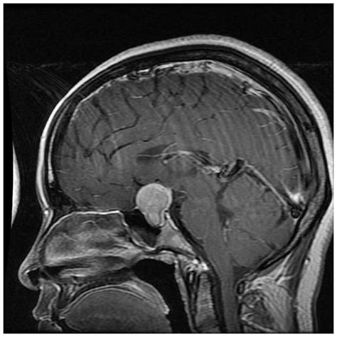 Pituitary Tumor Mri