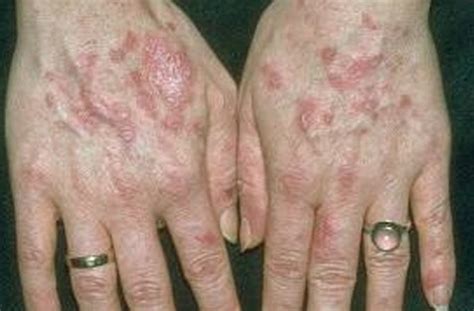 👉 Discoid Lupus - Pictures, Symptoms, Treatment, Causes (December 2021)