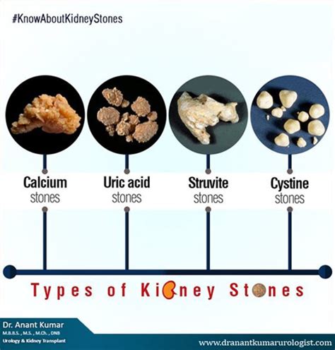 Cystine Kidney Stones