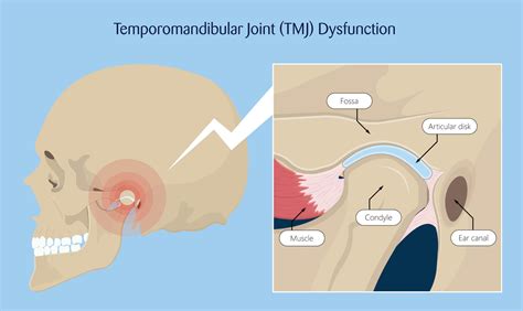 TMJ (Temporomandibular Joint) Disorders: Symptoms And More, 58% OFF