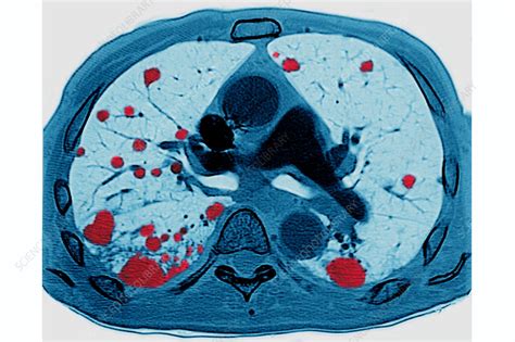 Lung Metastases, CT Scan - Stock Image - C030/6798 - Science Photo Library