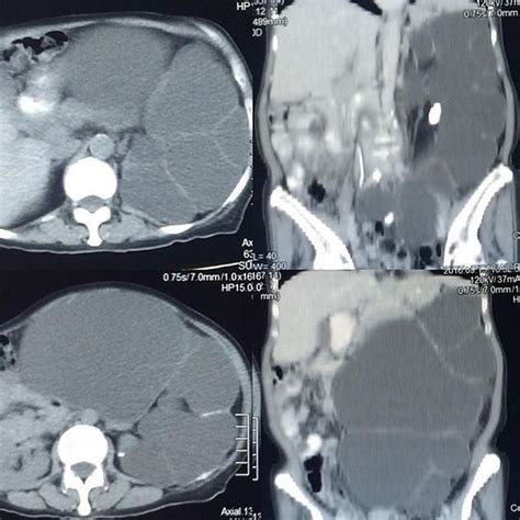 Hydronephrosis - MEDizzy