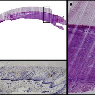 (PDF) Case of onychopapilloma presenting as longitudinal melanonychia