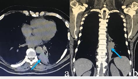 CT demonstrating the left hilum involving the left lung bronchus (a ...