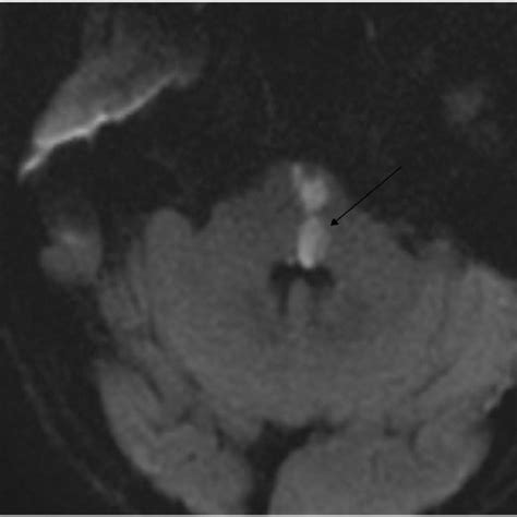 Left pontine infarct on MRI (arrow). | Download Scientific Diagram