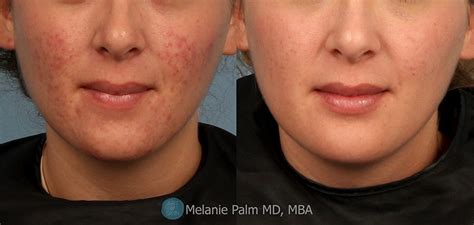 Acne Scarring Before and After -Acne Scarring Treatment