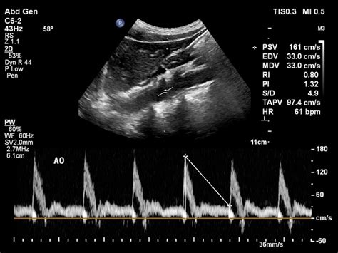 Normal Kidney Ultrasound