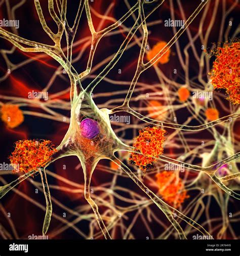 Alzheimer's disease. Illustration of amyloid plaques amongst neurons ...