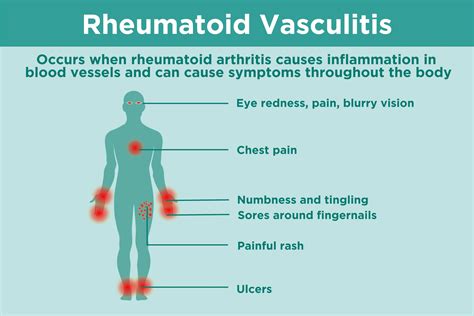 Vasculitis Symptoms