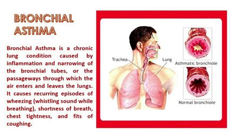 "Bronchial Asthma" and wonder what it means? - YouTube