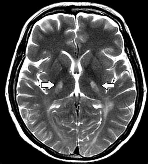 Adult Leukodystrophies: A Step-by-Step Diagnostic Approach | RadioGraphics