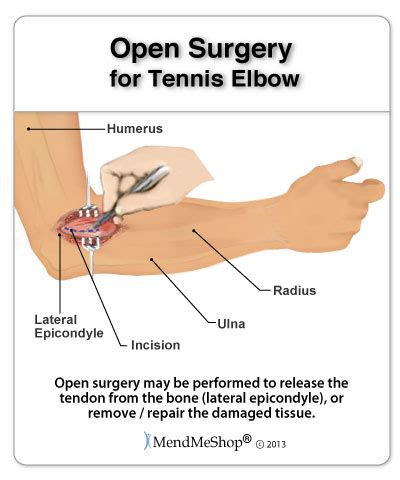 Surgical Treatments for Tennis Elbow- Open Surgery and Arthroscopic Surgery