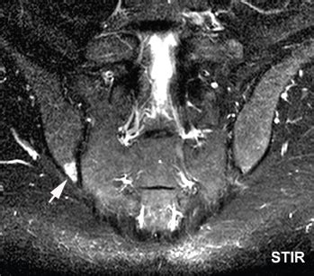 bone marrow edema sacroiliac joint treatment - stanovich-spillers