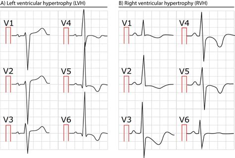 ECG in left ventricular hypertrophy (LVH): criteria and implications ...