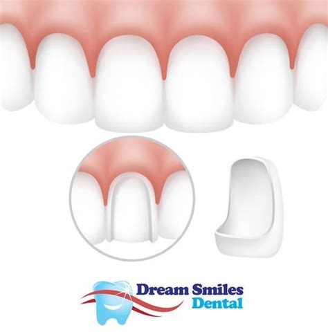 High-Quality Porcelain Veneers | Dental veneers, Dental, Porcelain veneers