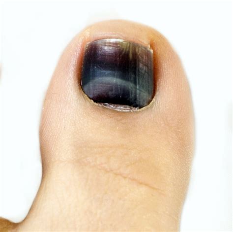 Why has my toenail turned black? - The Chiropody Clinic Enfield