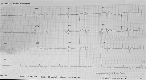 Anterior Wall M.I. With Ventricular Bigeminy | ECG Guru - Instructor ...