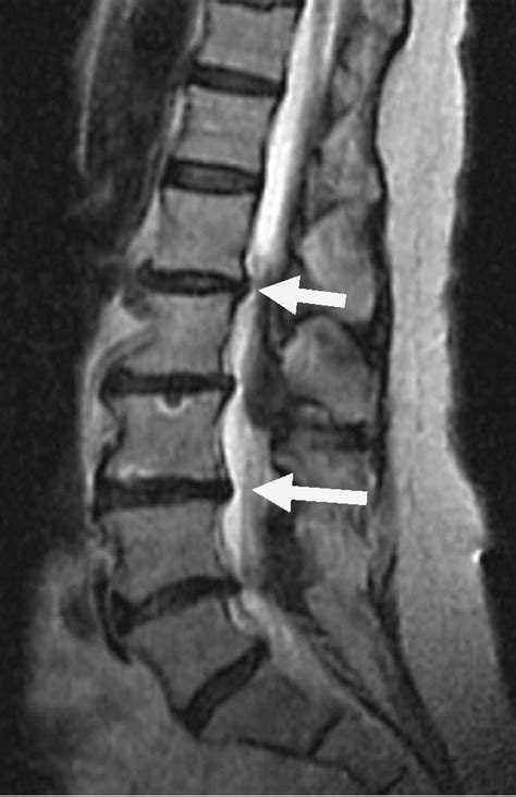 Thoracic Spine Mri Herniated Disc