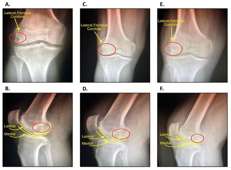 Subchondral Fracture Medial Femoral Condyle