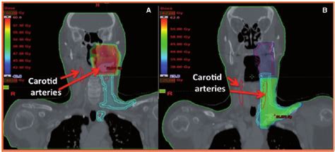 Typical radiation treatment plan for a left tonsil cancer, showing dose ...