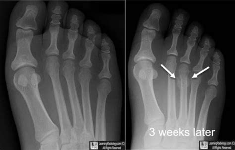 Mri Of Foot Stress Fracture